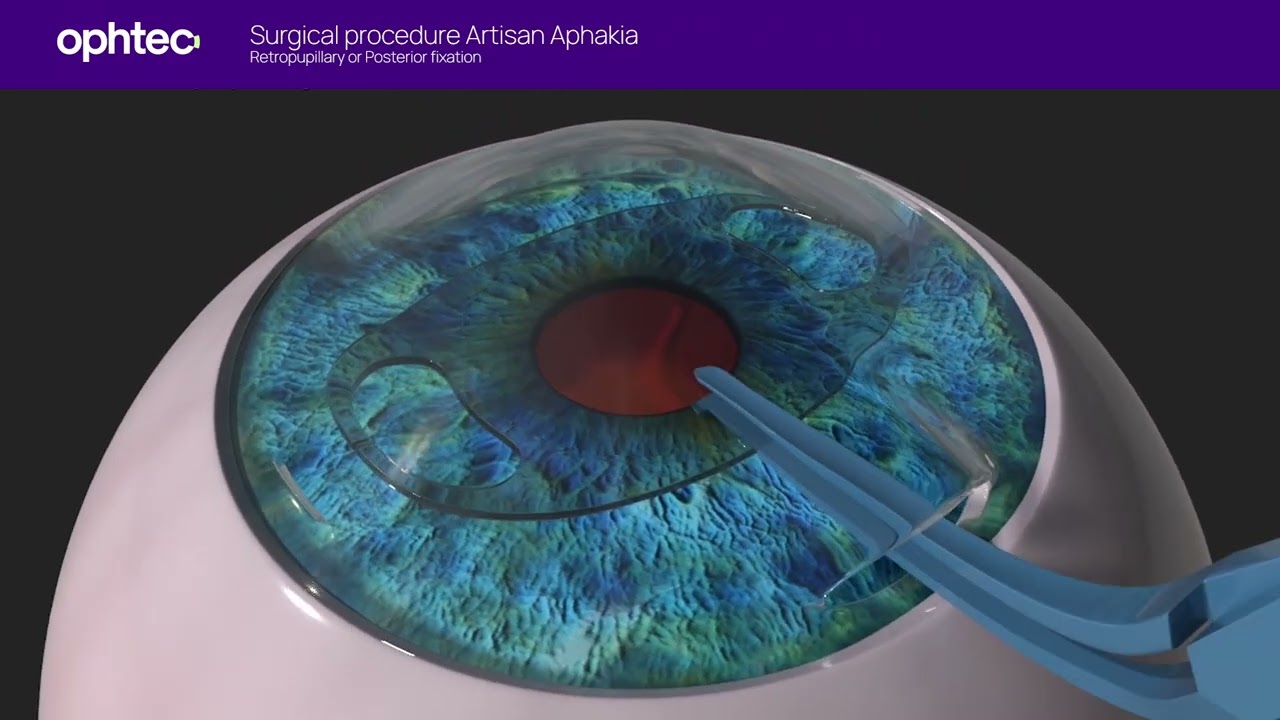 Ophtec Artisan Aphakia retropupilar implantation animation