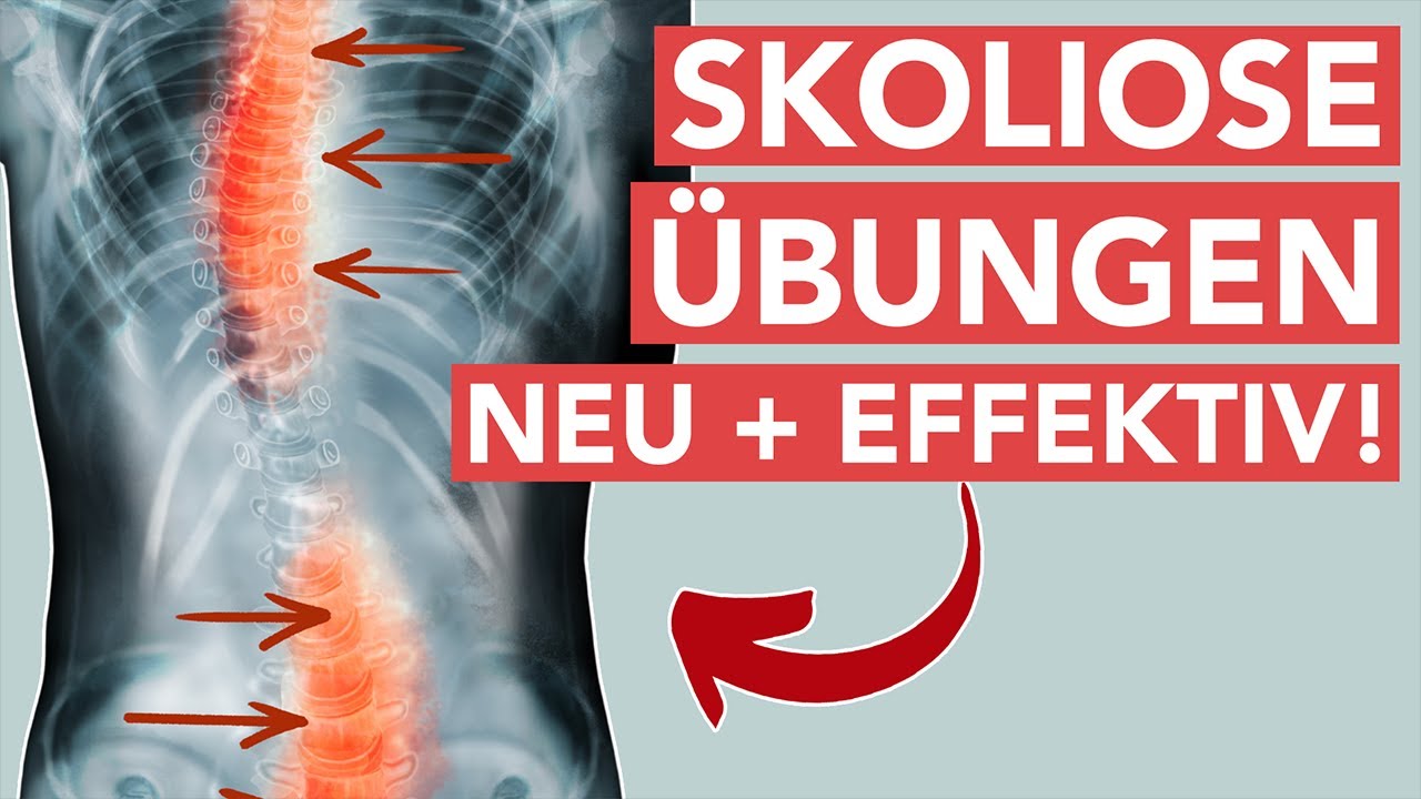 Skoliose übungen - Neue effektive Behandlungsmethode