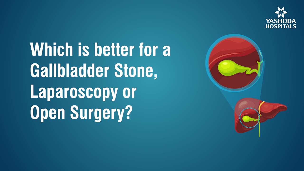 Which is better for a Gallbladder Stone, Laparoscopy or Open Surgery?