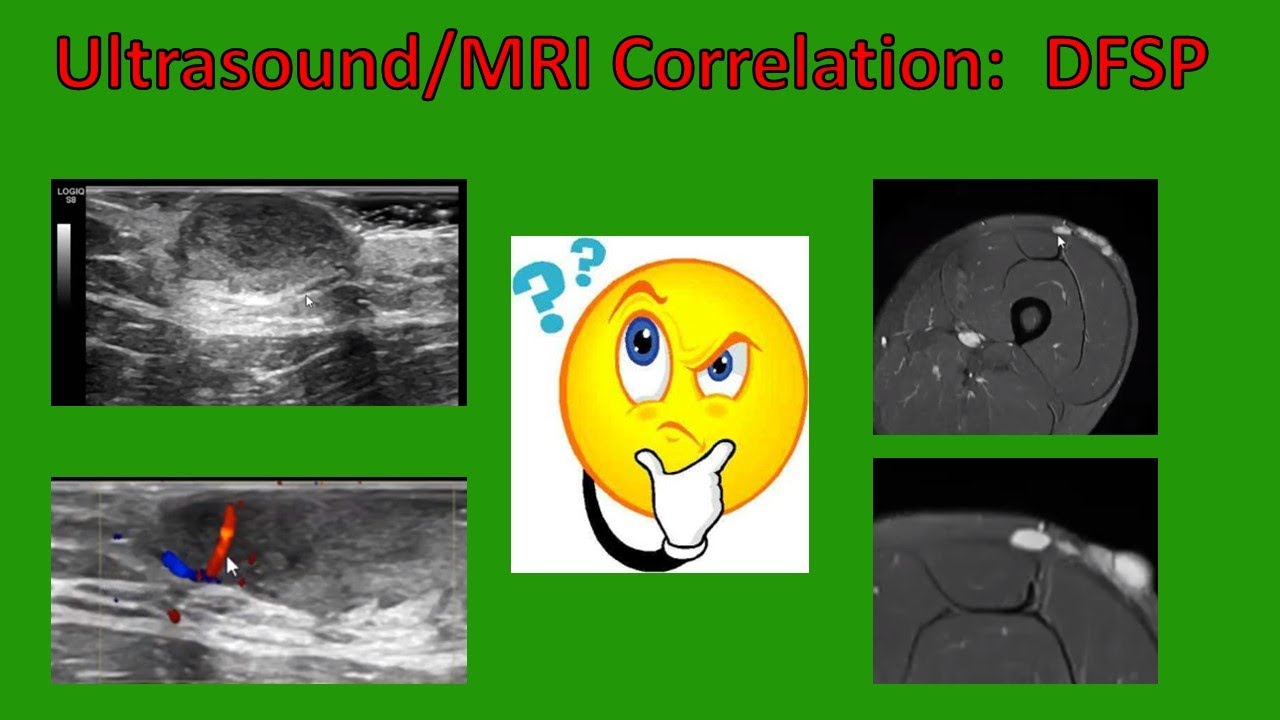 Ultrasound / MRI Mass Correlation:  Dermatofibrosarcoma Protuberans (updated 2020)