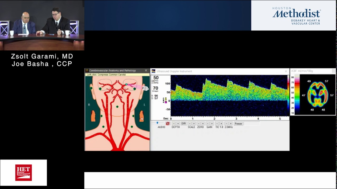TCD Basics For The Perfusionist  (Zsolt Garami MD) Utilization of TCD for Primary Stroke Prevention
