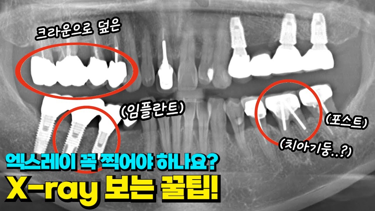 치과 엑스레이 꼭 찍어야하나요?! X-ray 보는 꿀팁!