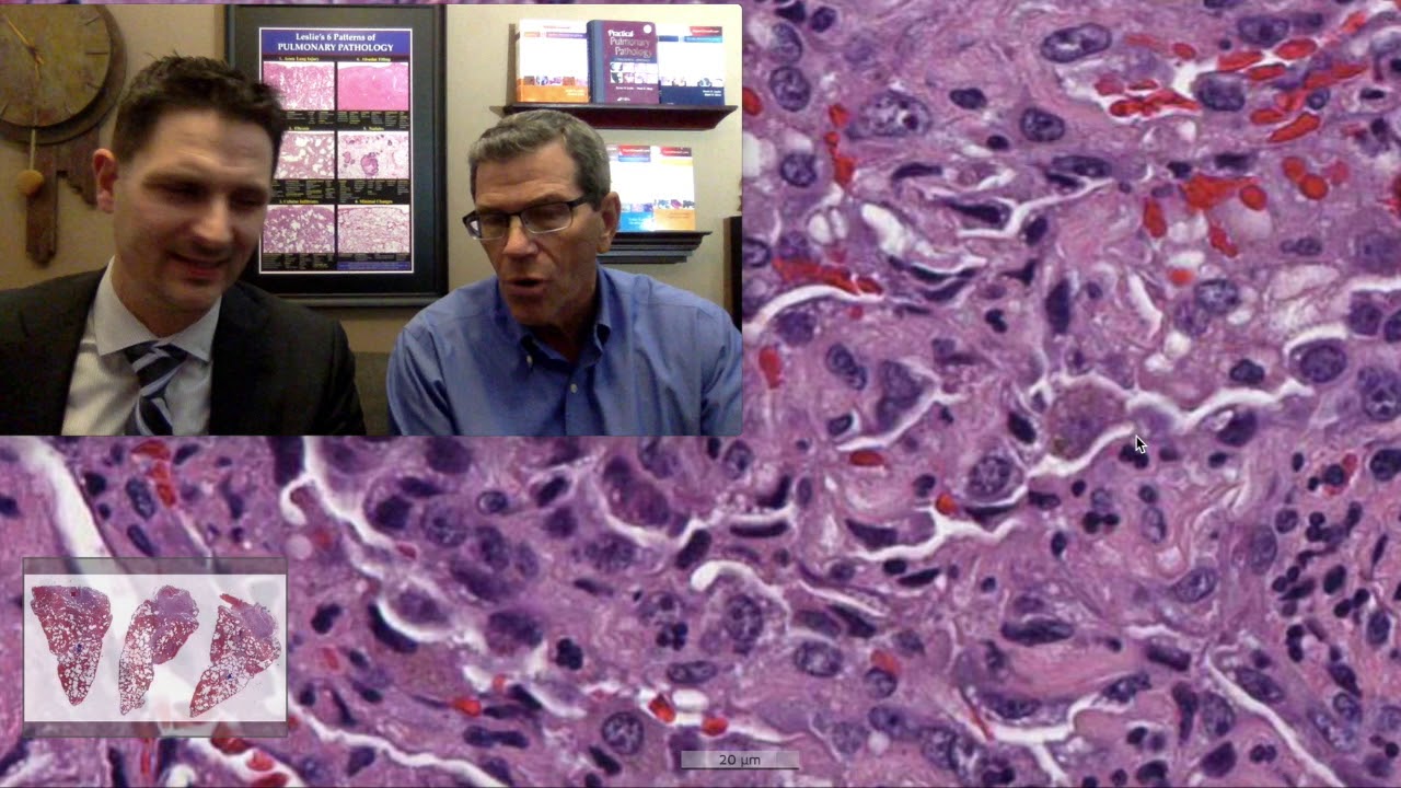 Pattern 4 – Alveolar Filling, Diffuse Alveolar Hemorrhage (Top 25 Pearls Series, Topic 6, Pearl 1)