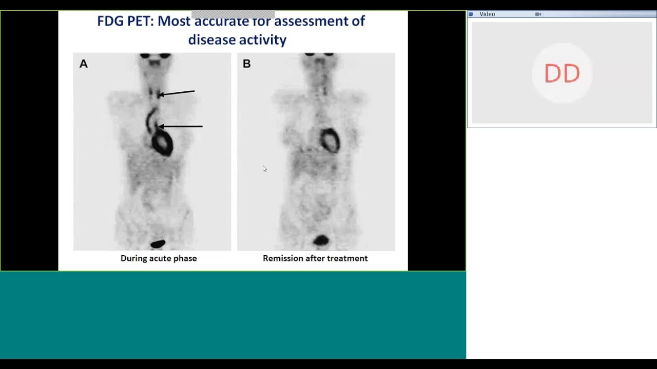 Aortoarteritis by Dr Anita Saxena