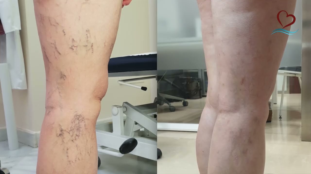 Tratamiento de varices con Microespuma. Antes y despu&eacute;s.