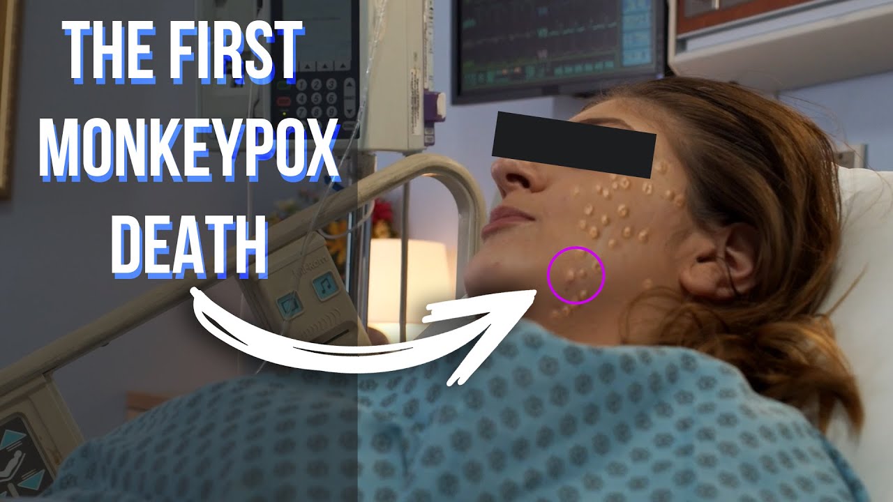 The first Monkeypox Death