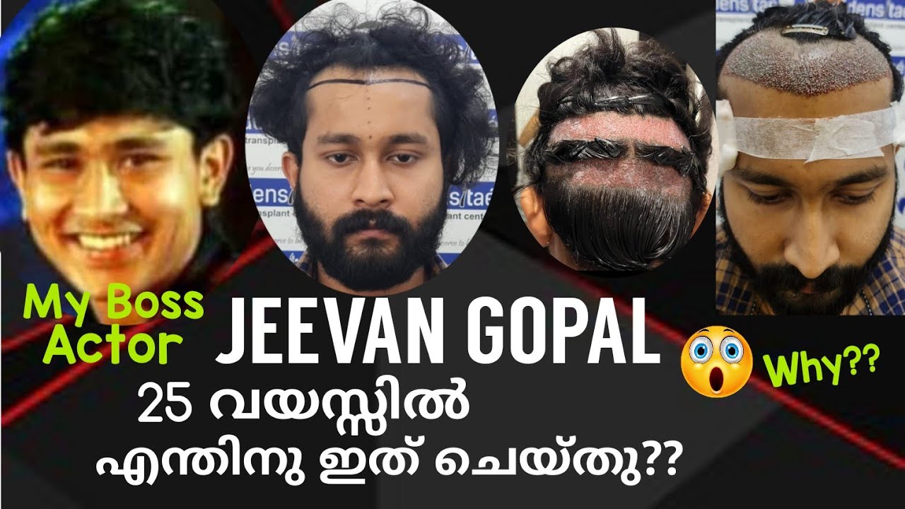 മുടി വെച്ഛ് പിടിപ്പിച്ച രഹസ്യം വെളുപ്പെടുത്തി Actor Jeevan അതും ഏറ്റവും New Saphire FUE👌video കാണു