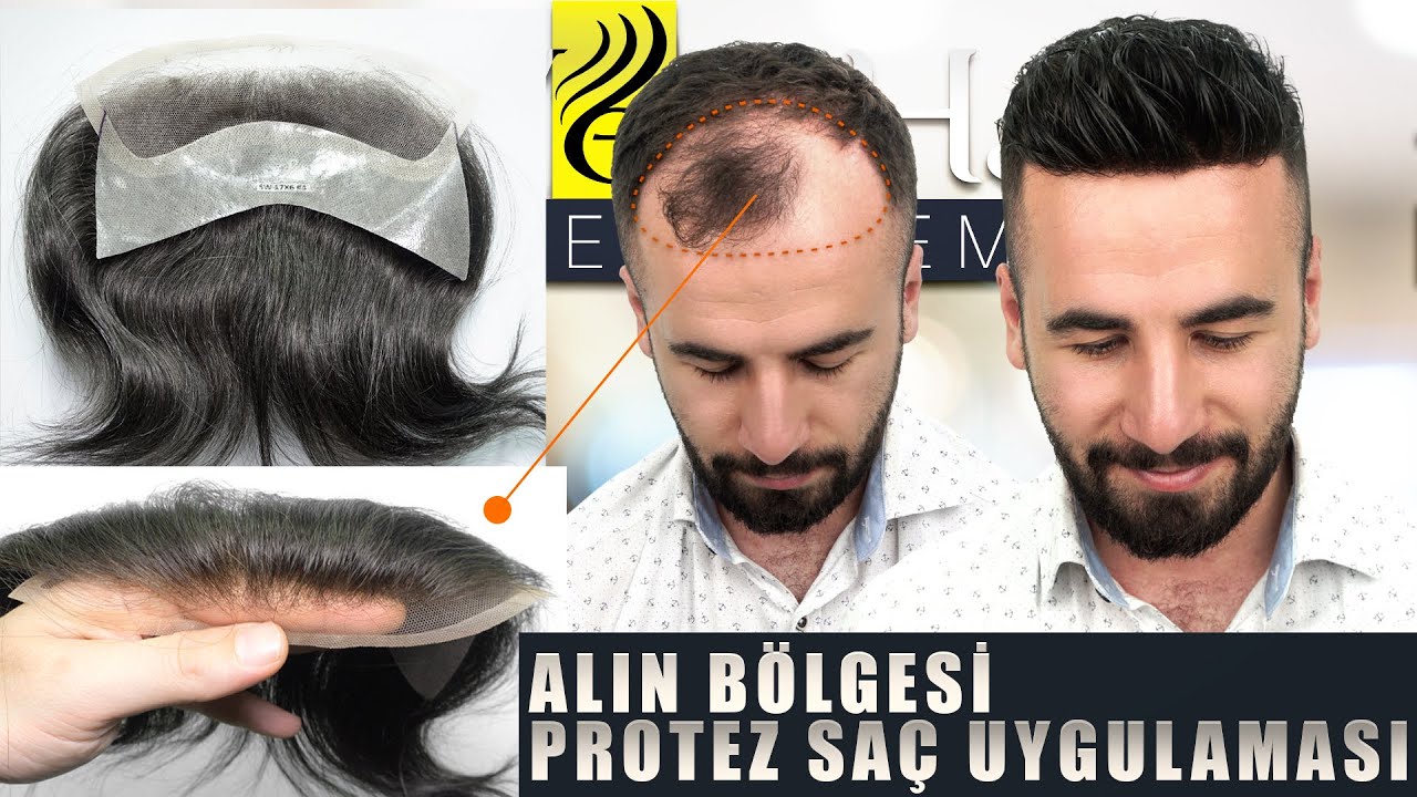 Alın Bölgesi Protez Saç Uygulaması