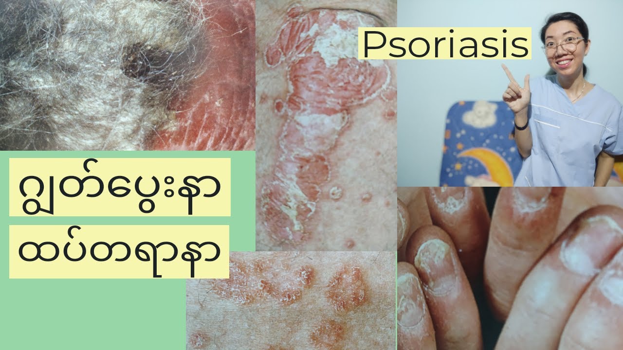 Psoriasis သိသင့်သောအရေပြားဂျွတ်ပွေးနာခေါ်ထပ်တရာနာ