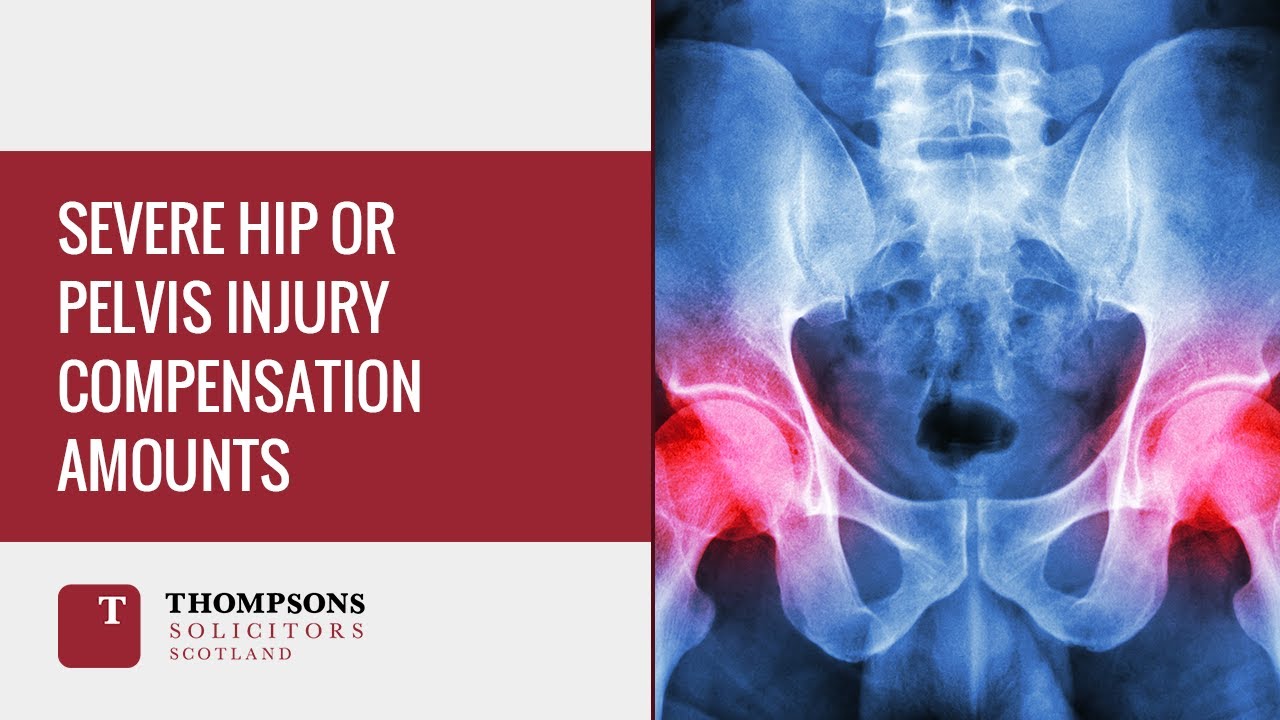 Severe Hip or Pelvis Injury Compensation Amounts
