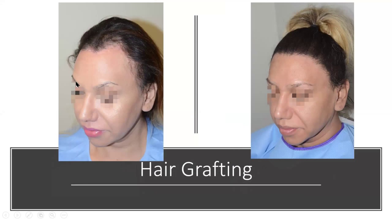 Lowering the Overly High Hairline in Women and Men