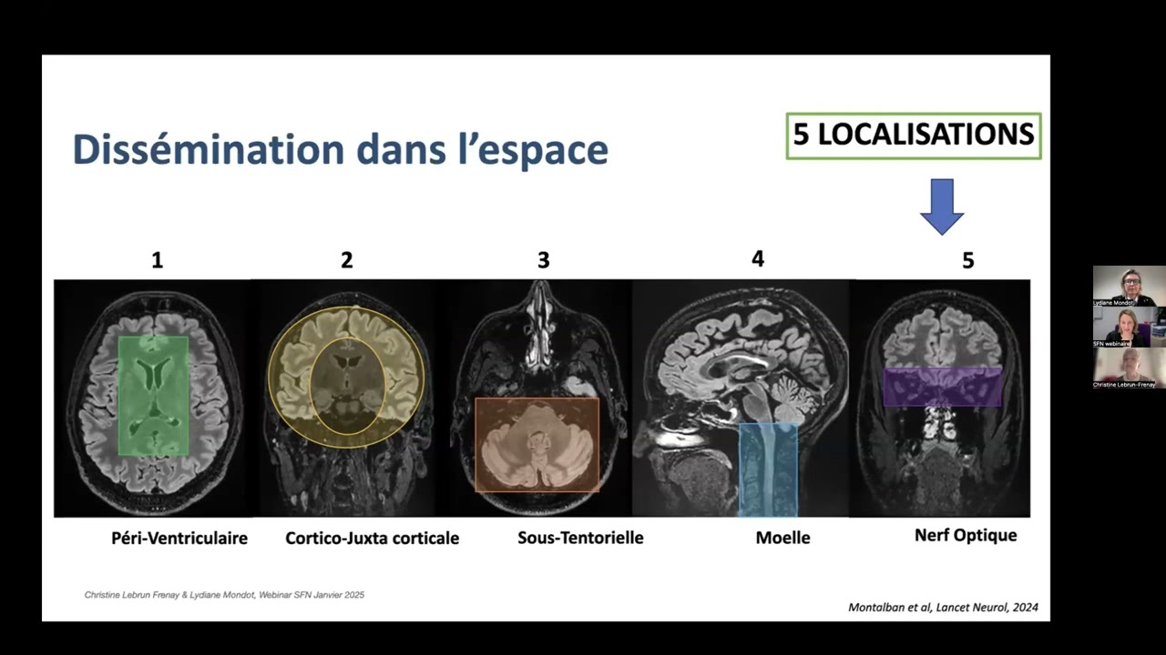 Webinaire SFN / ANAINF / ANLLF: Critères diagnostiques de la SEP en 2024