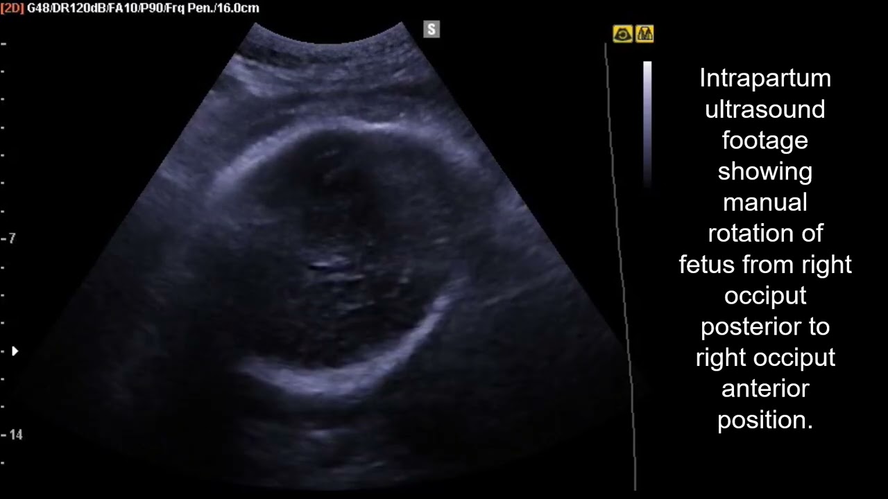 Real-time ultrasound demonstration of successful manual rotation of fetal occiput posterior position