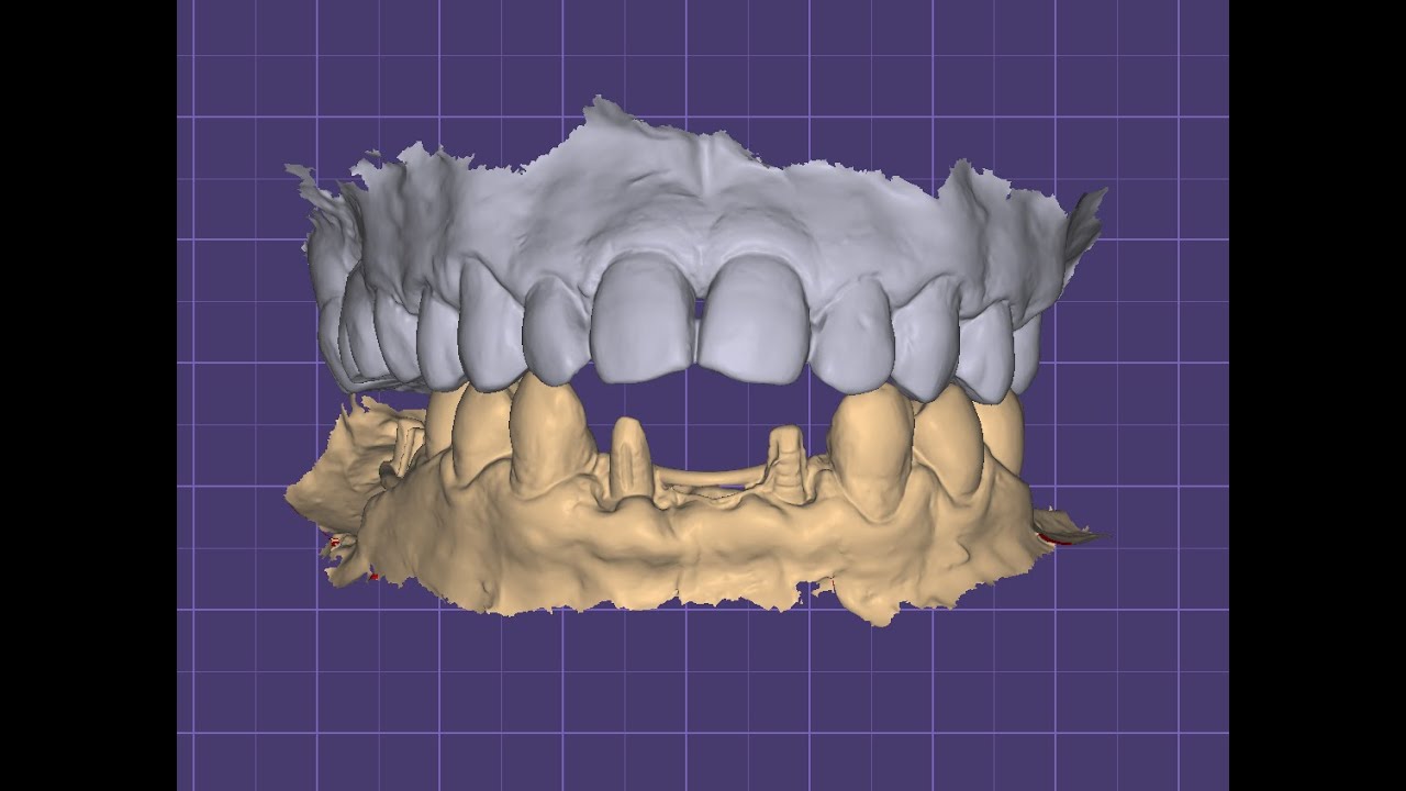 Designing in lower anterior and posterior pmma bridge in exocad..