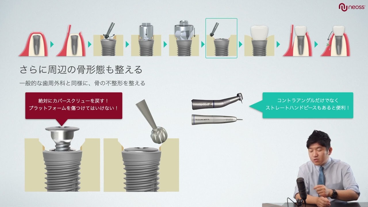 ゼロから始めるインプラント　～補綴編～
