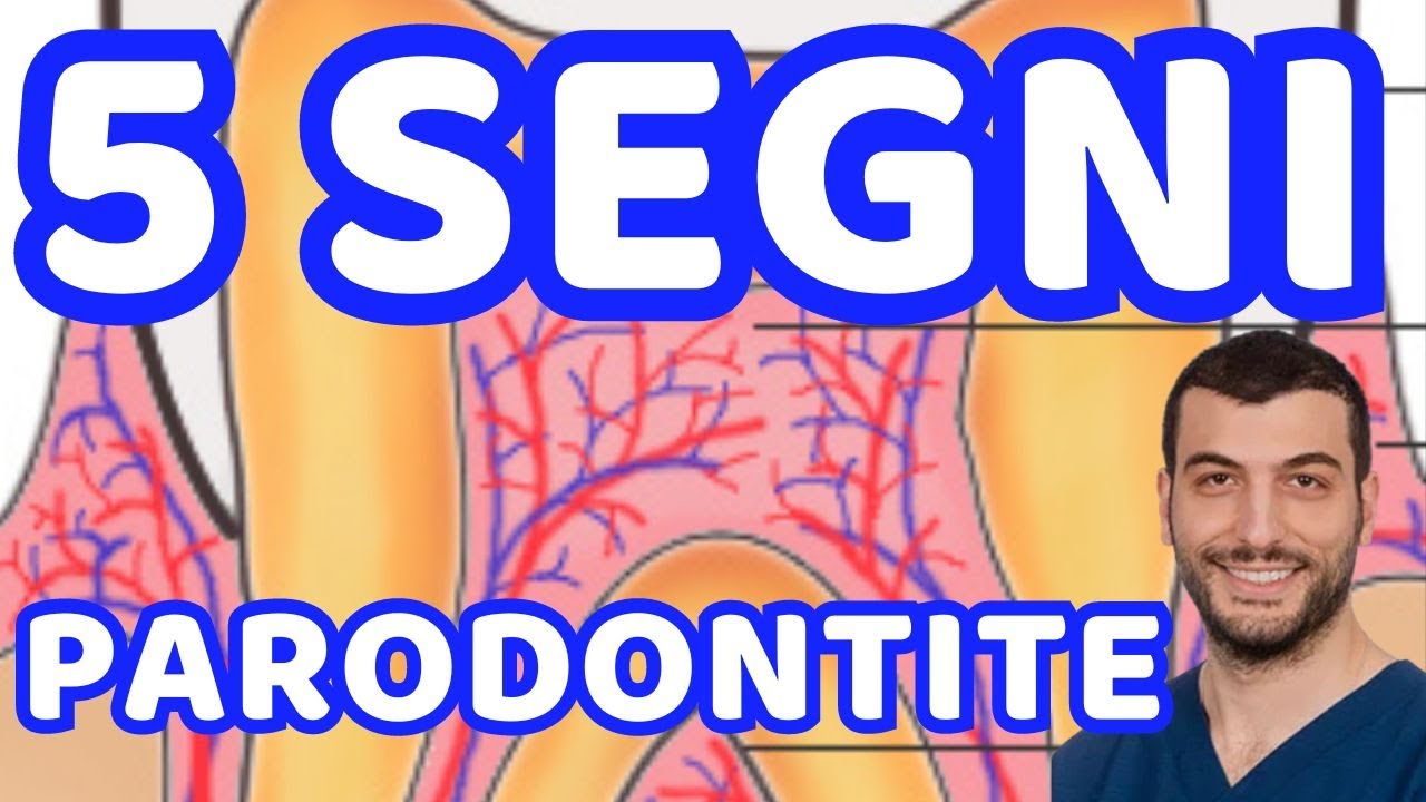 5 Segni che hanno i Denti con Parodontite