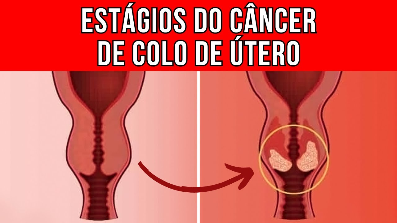 Quais são os estágios do CÂNCER DE COLO DE ÚTERO?