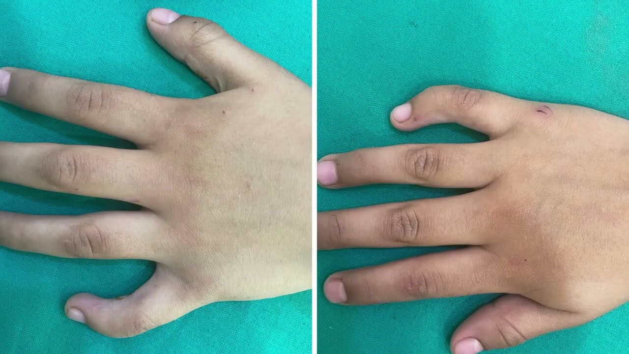 Born finger deformity correction surgery | टेडी ऊँगली का किया सफल इलाज