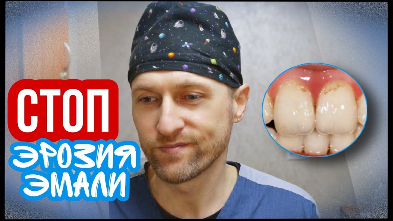 Эрозия Эмали