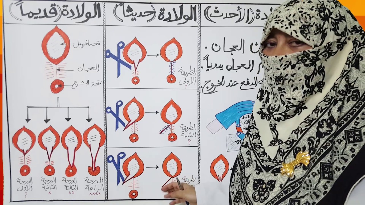 هل الافضل شق العجان وعمل خياطة مع الولادة الطبيعية؟؟