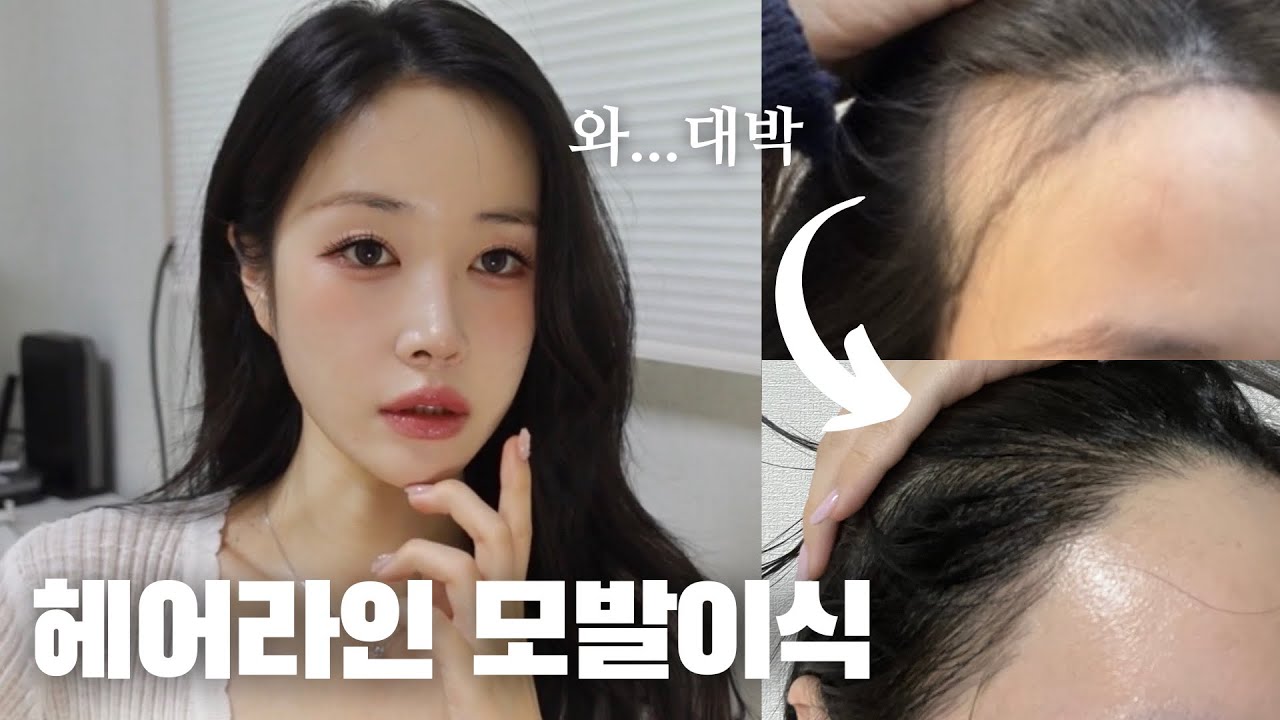 이거 하고 딴사람 됨.. 만족도 최상 M자 헤어라인 3200모 6개월차 솔직 후기‼️ ( 전후 차이 | 통증 | 탈모 해결법 )