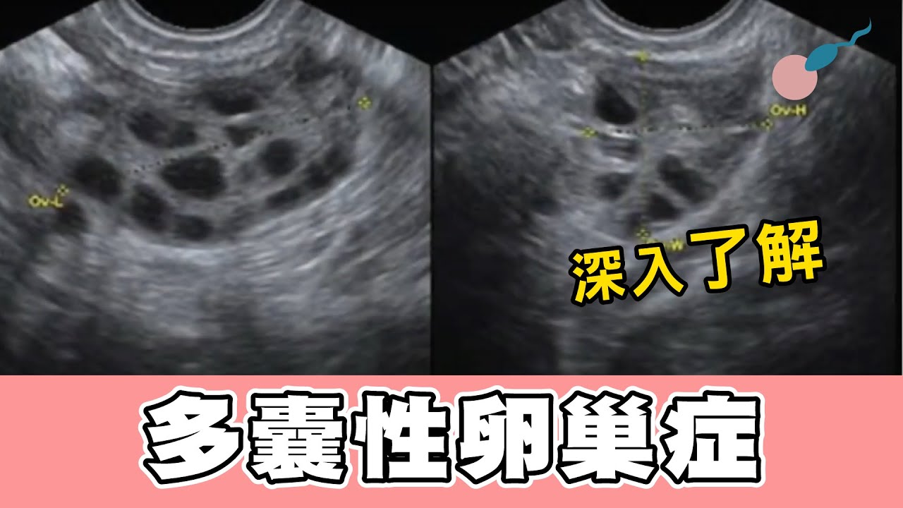 多囊卵巢綜合症為何不孕？！如何提高受孕率？［幸孕福］