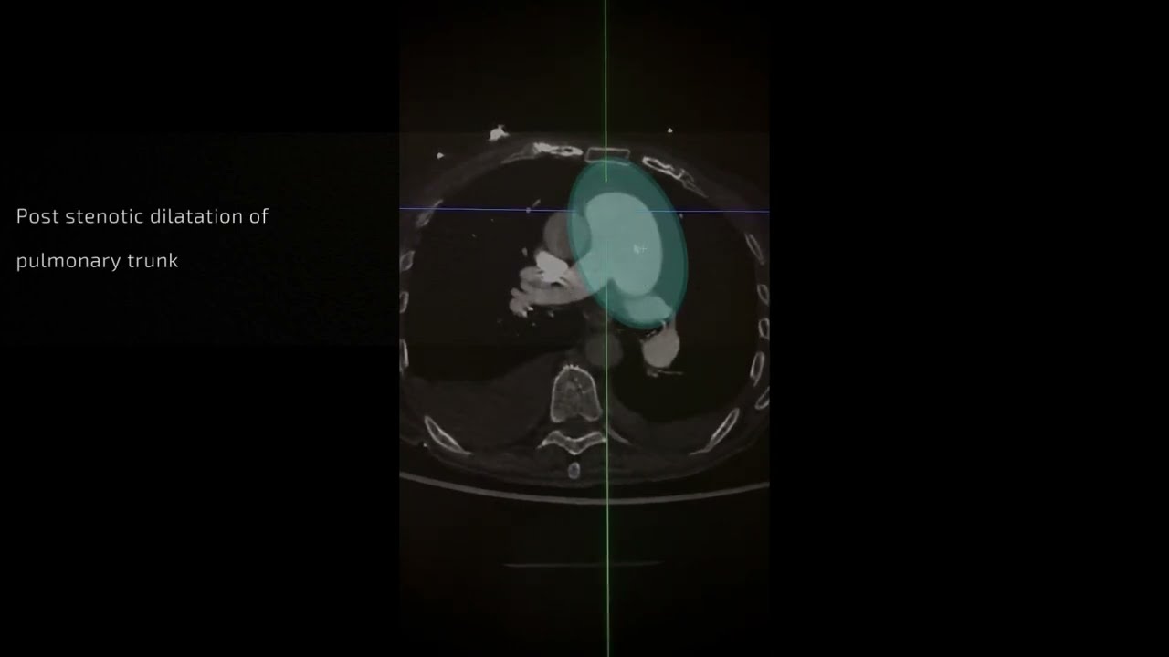 CT interpretation - pulmonary trunk dilatation pattern in pulmonary valve stenosis