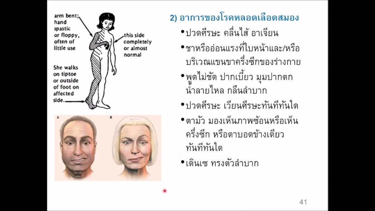 หัวข้อ 9.3 โรคที่พบบ่อยในผู้สูงอายุฯ (ตอนที่ 6/7) ... โรคหลอดเลือดสมอง