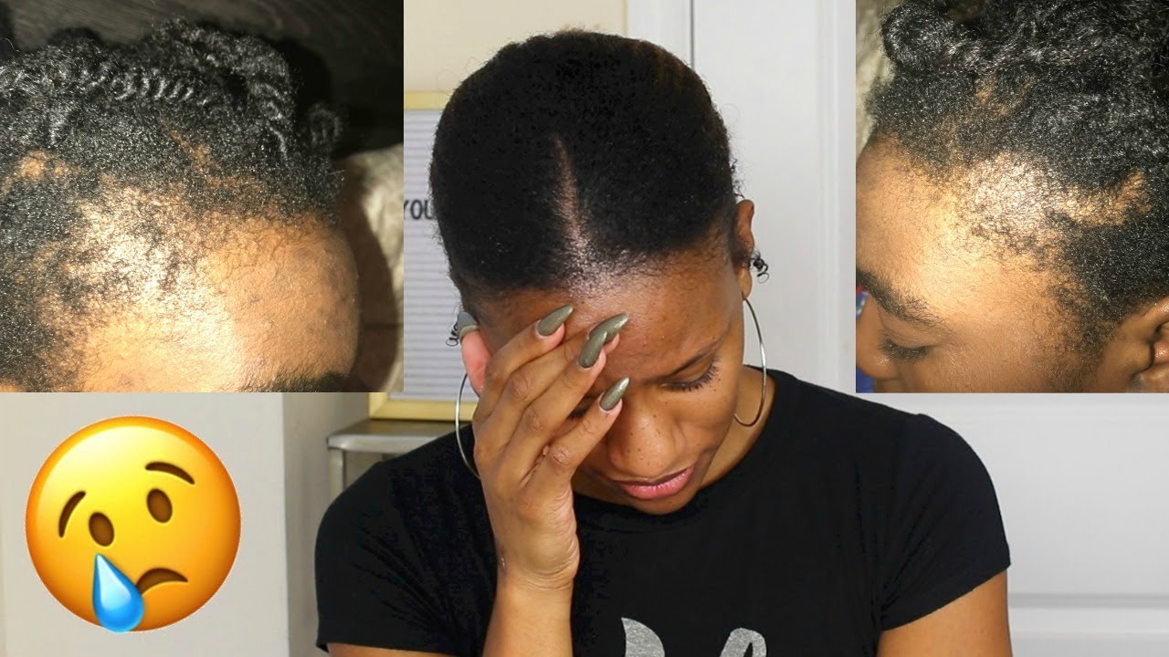 HOW I LOST MY HAIR AT 16! 😢 NATURAL HAIR HORROR STORY