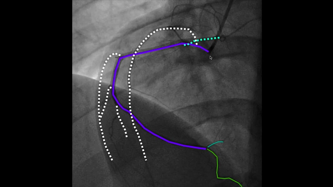 Narrated angiogram