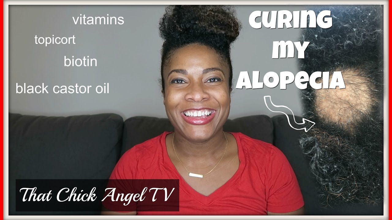 CURING MY ALOPECIA | That Chick Angel TV