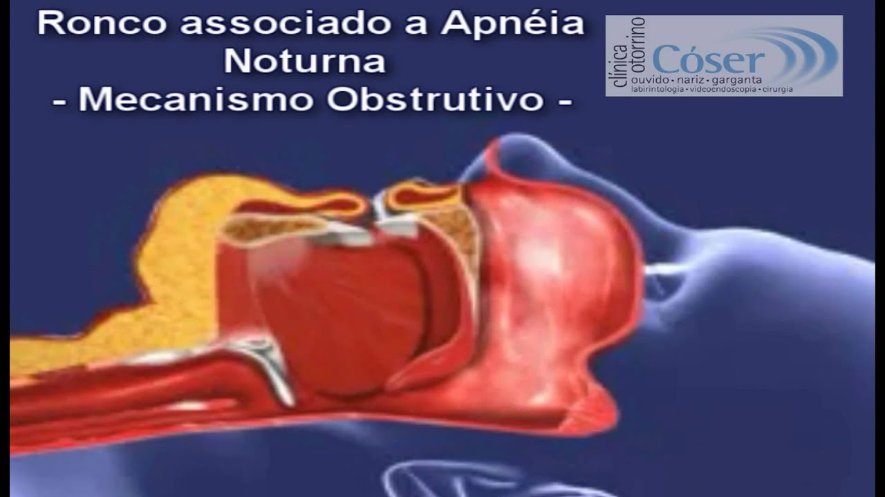 Ronco e Apn&eacute;ia - O que &eacute;, como acontece e tratamento com CPAP - Clinica ORL C&oacute;ser