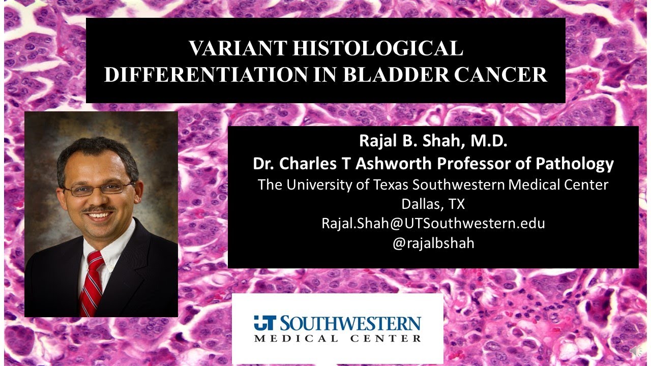 A Dummies Guide to Variant Histological Differentiation in Bladder Cancer
