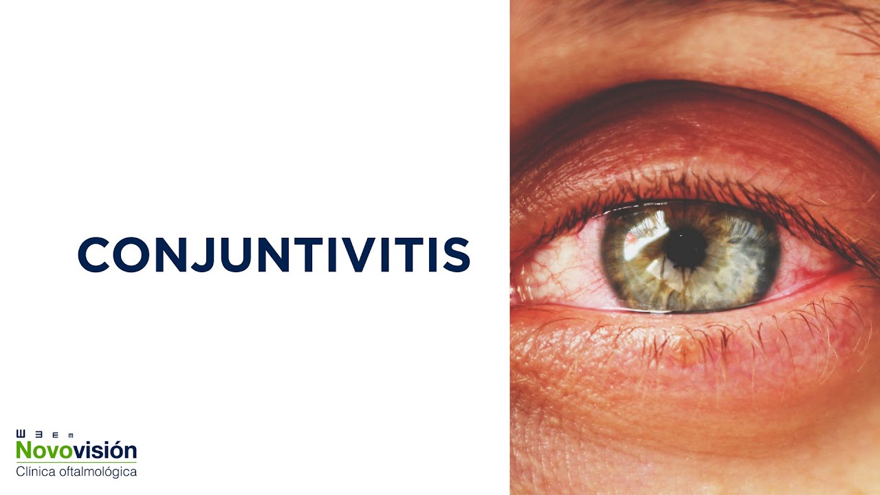 👉  Conjuntivitis: cuáles son sus síntomas y cómo podemos tratarla