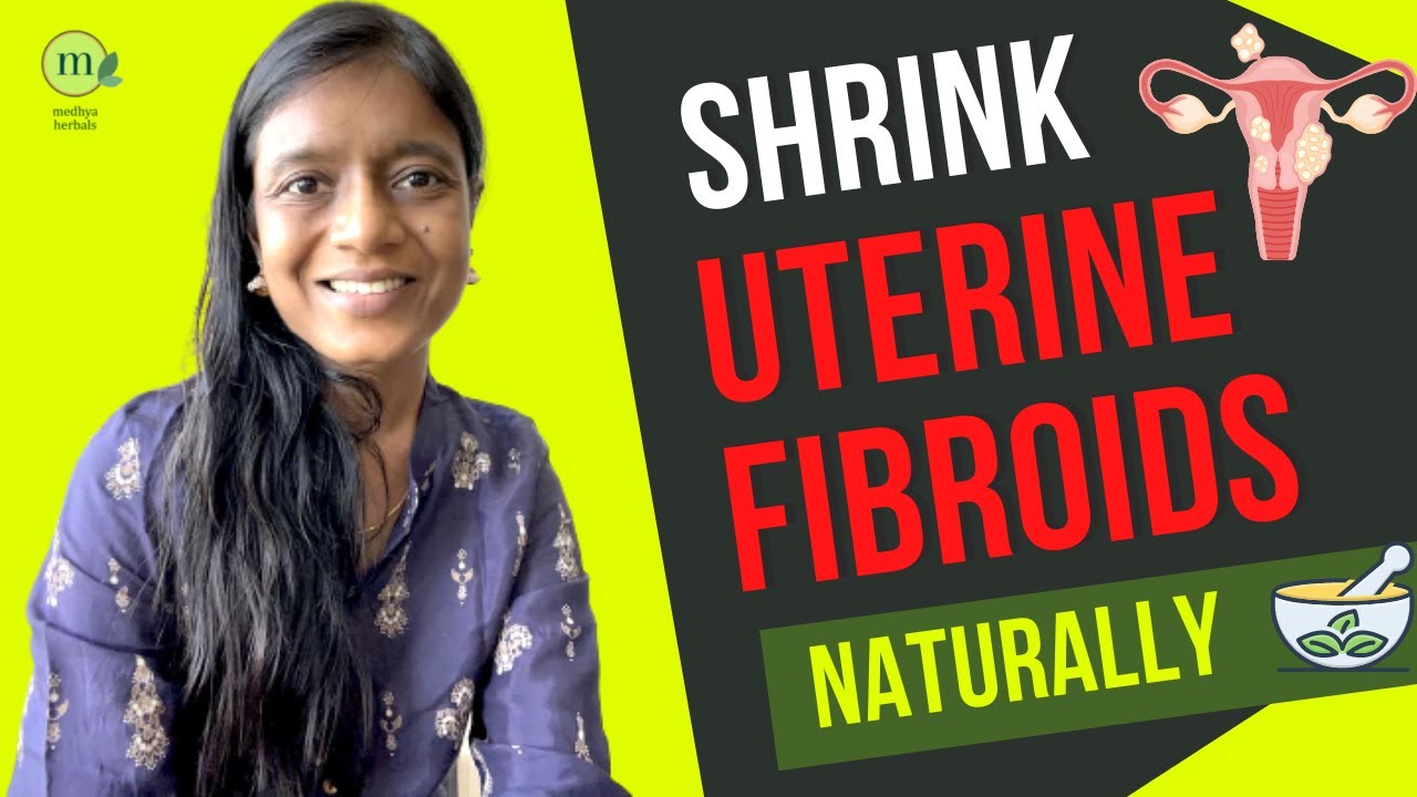 Shrink Uterine Fibroid with Ayurvedic Natural Treatment | 10 Best Herbs, Yoga and Diet Tips