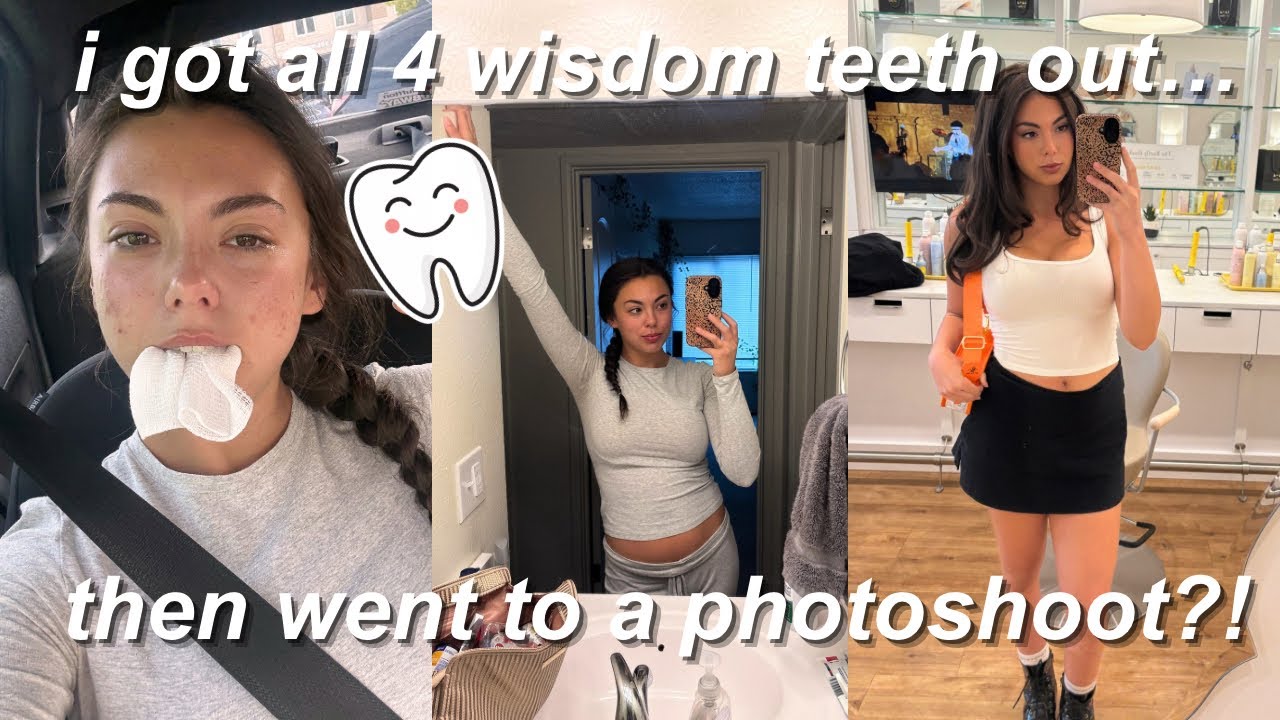 I GOT MY WISDOM TEETH OUT 🦷🪥✨ (CAN’T BELIEVE I’M POSTING THIS?!?)