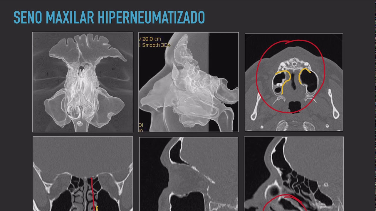Anatomía Senos Paranasales  Parte 2 Radiología Diagnóstico por Imagen