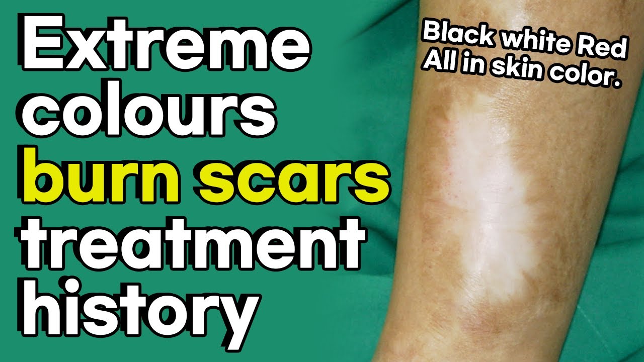 История лечения шрамов от ожогов: экстремальные цвета, черный, белый, красный