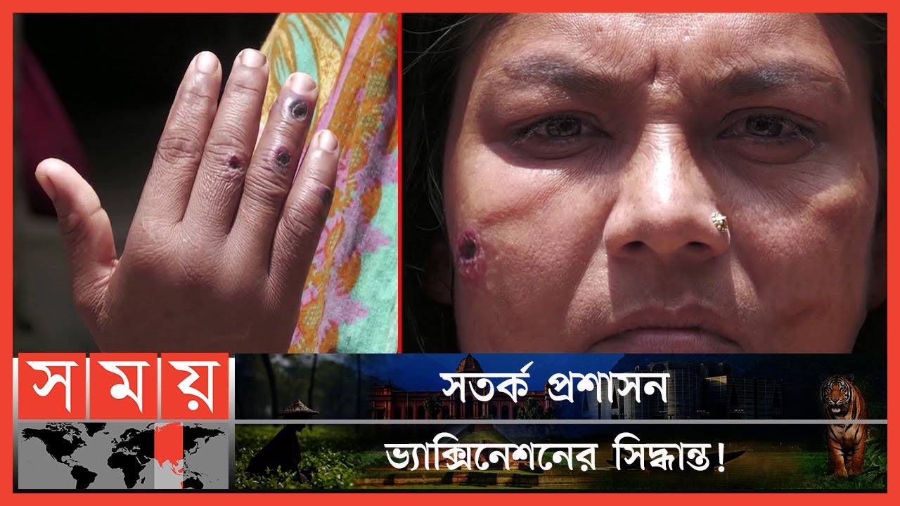 গরু থেকে অ্যানথ্রাক্স রোগে আক্রান্ত অনেকে! | Anthrax Disease | Natore News | Somoy TV