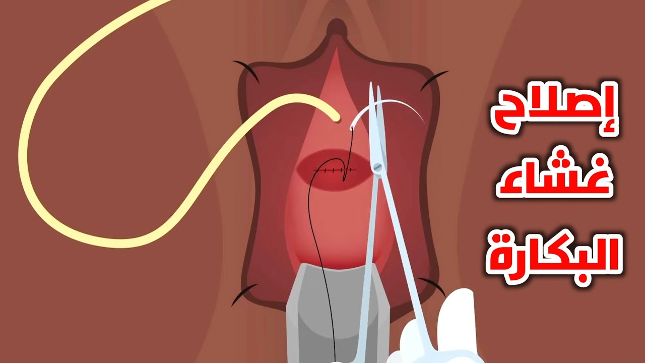 شاهد عملية اصلاح غشاء البكارة (Hymenoplasty)