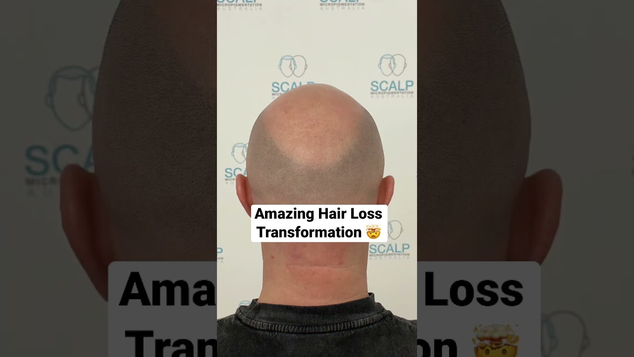 No. 1 Hair Loss Treatment 🤯 #shorts #scalpmicropigmentation #hairloss #smp #beforeandafter