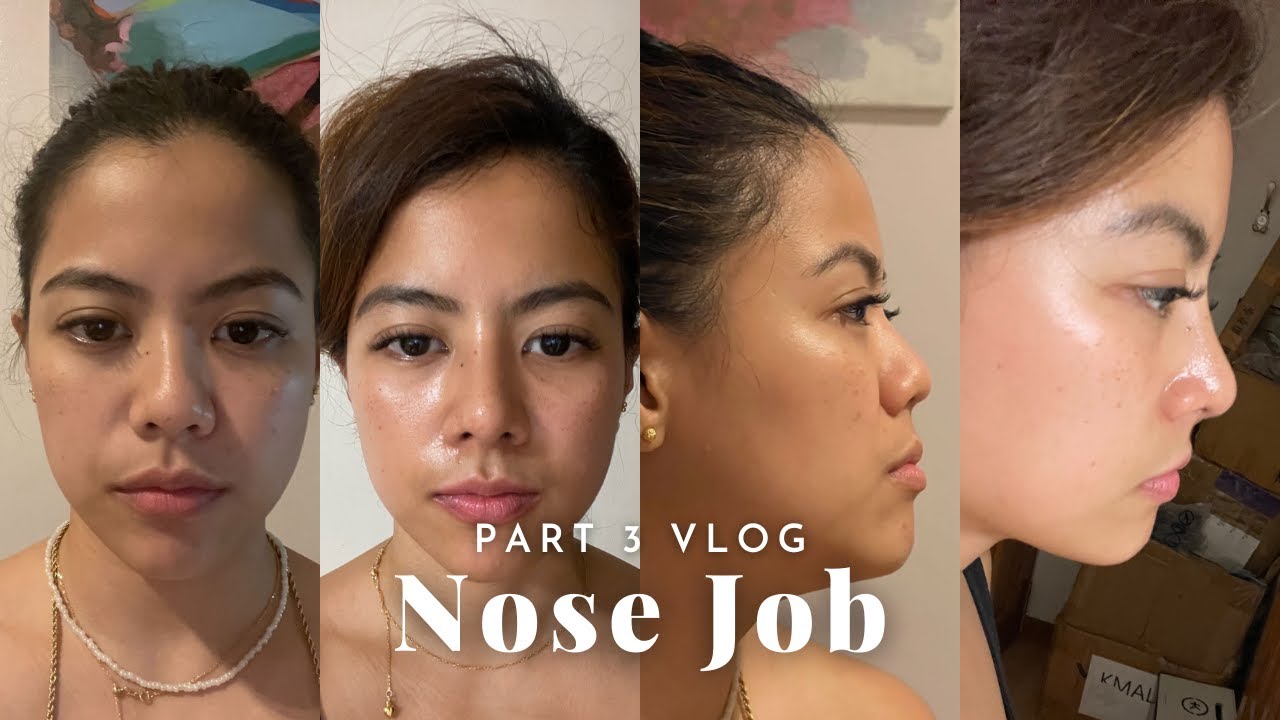 PART 3: Rhinoplasty Diaries | 3 months BELO Doc Nato 💎Paula Coling