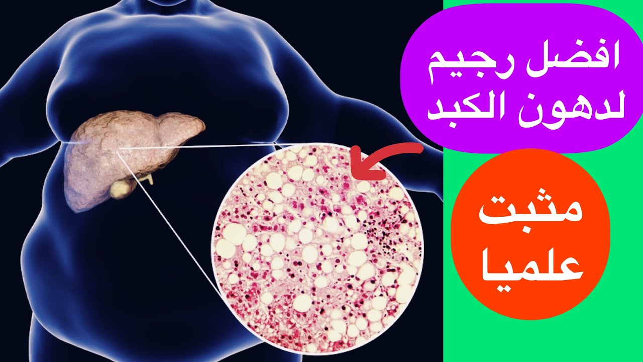 الكبد الدهني ! افضل نظام غذائي مثبت علميا ل علاج دهون و تشحم الكبد 2021
