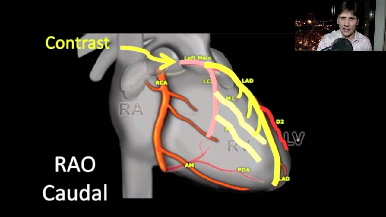 Posterior MI