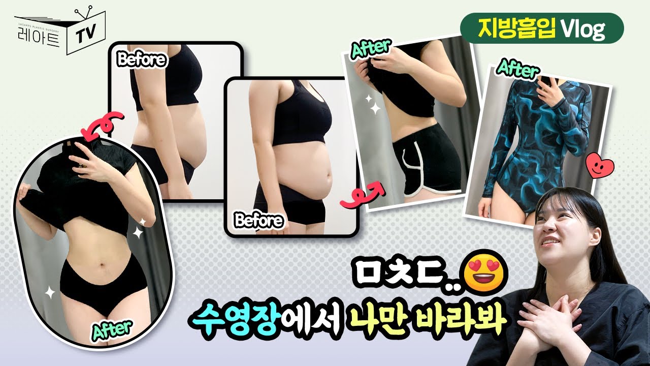 [팔 복부 지방흡입] 수영장 갔더니 사람들이 나만 봐😍 [레아트성형외과]