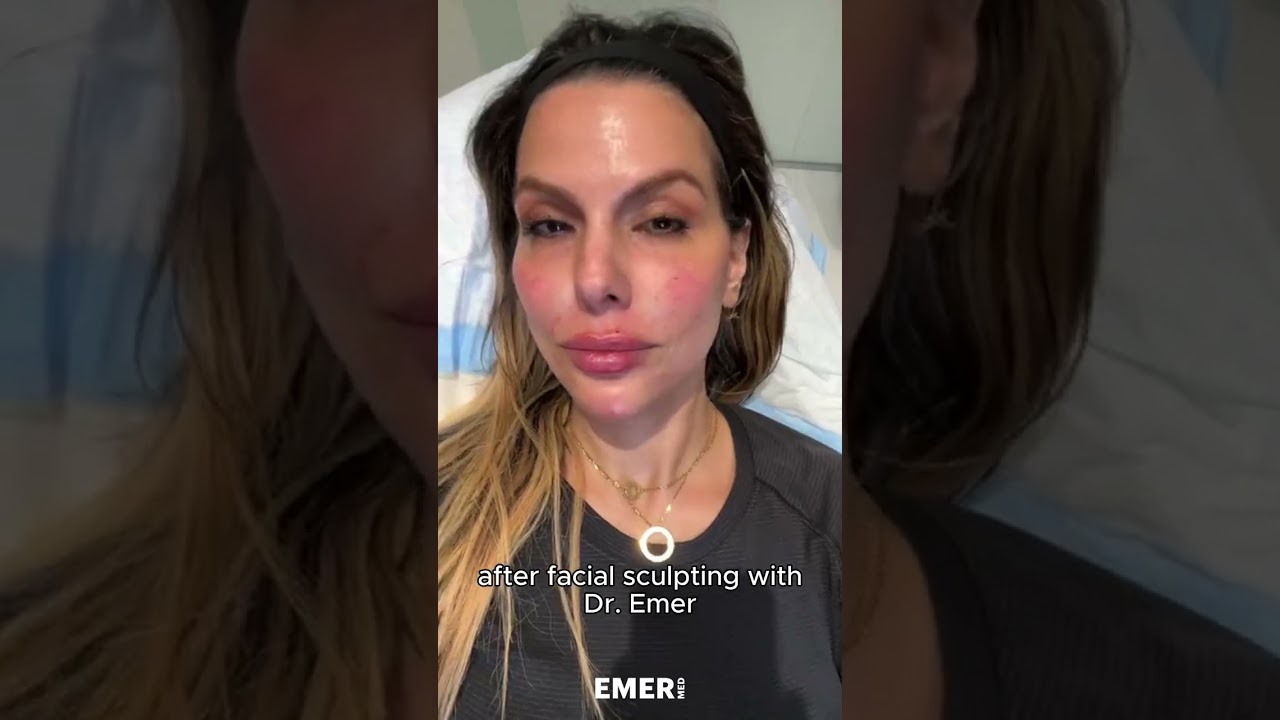 SNATCHED FEMALE FACIAL SCULPTNG | Dr. Jason Emer