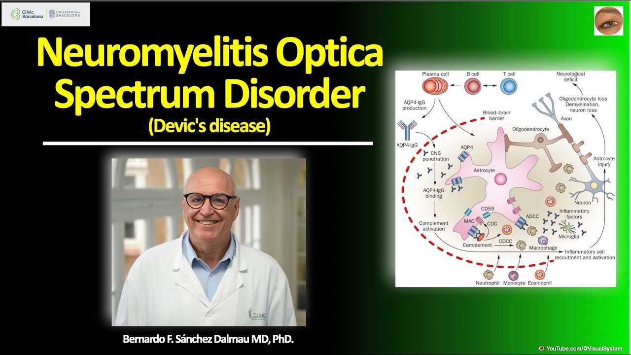 Neuromielitis Óptica || Enfermedad de Devic || #opticneuritis #neuromyelitis