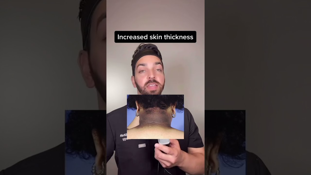 Темная шея &mdash; DermDoctor объясняет Acanthosis Nigricans #shorts