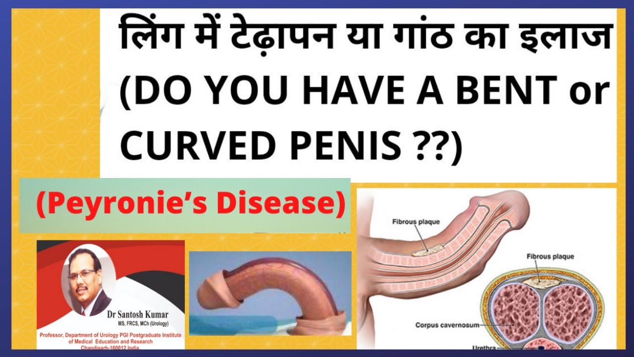 ling me dard ganth aur tedhapan peyronies disease | peyronies disease टेढ़ा लिंगDr.Santosh Kumar PGI