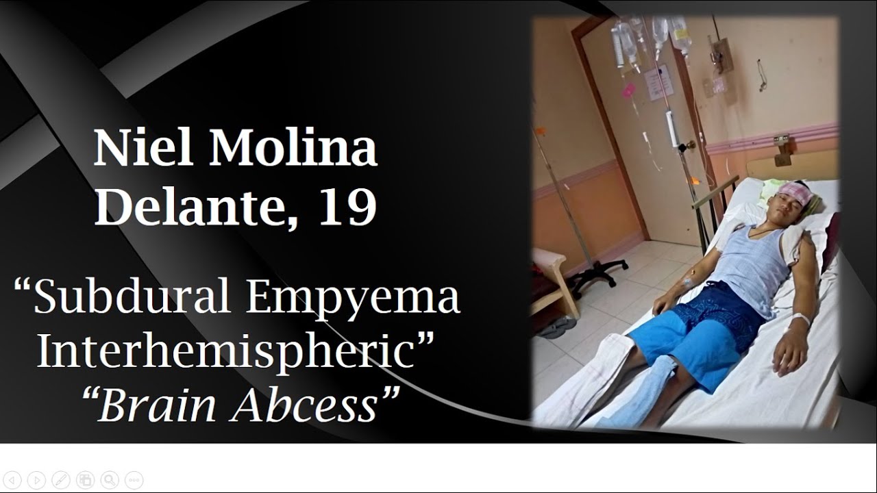 Brain Abcess/Subdural Empyema Interhemispheric, Seizures